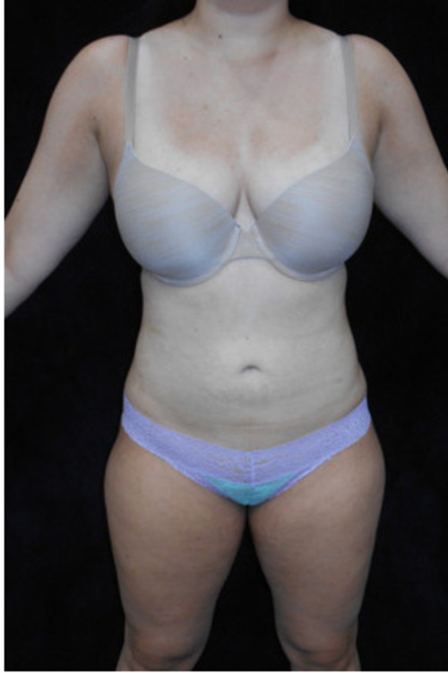 Liposuction - Body