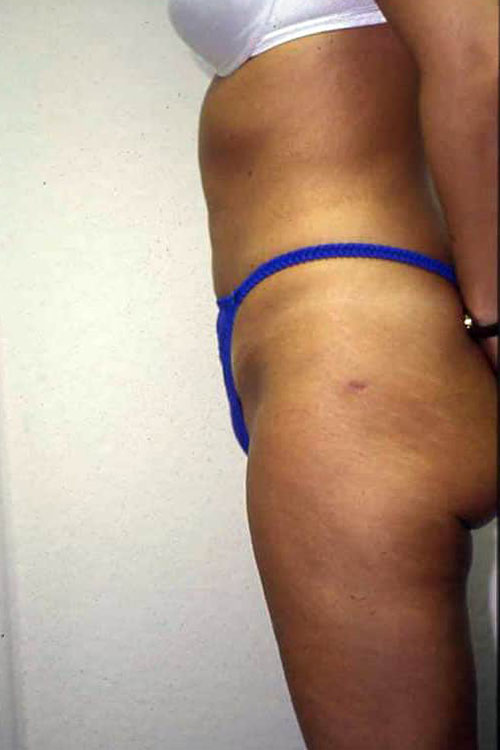 Liposuction - Body