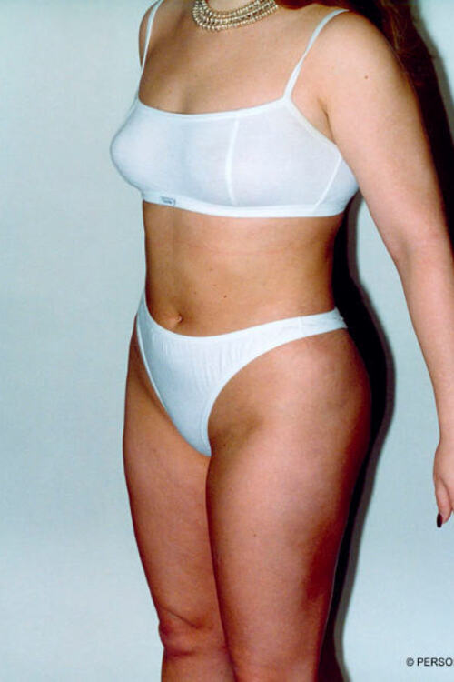 Liposuction - Body