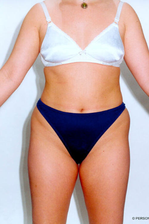 Liposuction - Body