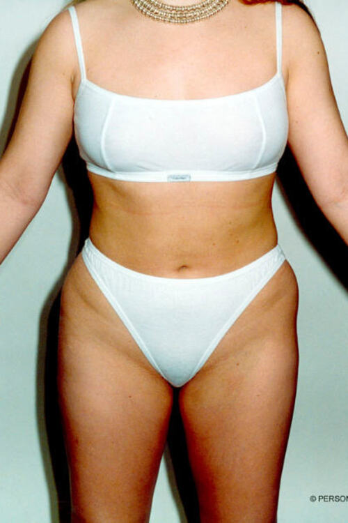 Liposuction - Body