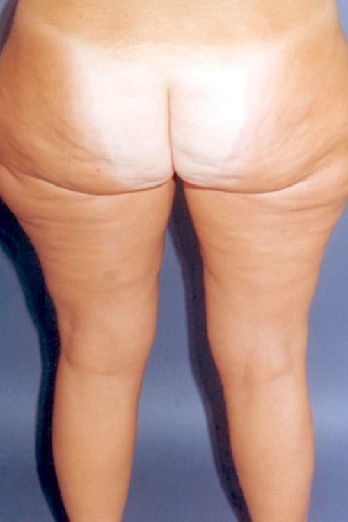 Liposuction - Body