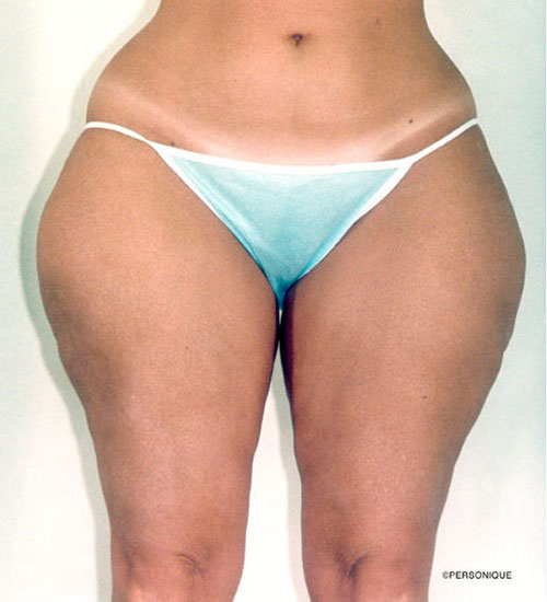 Liposuction - Body