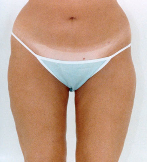 Liposuction - Body