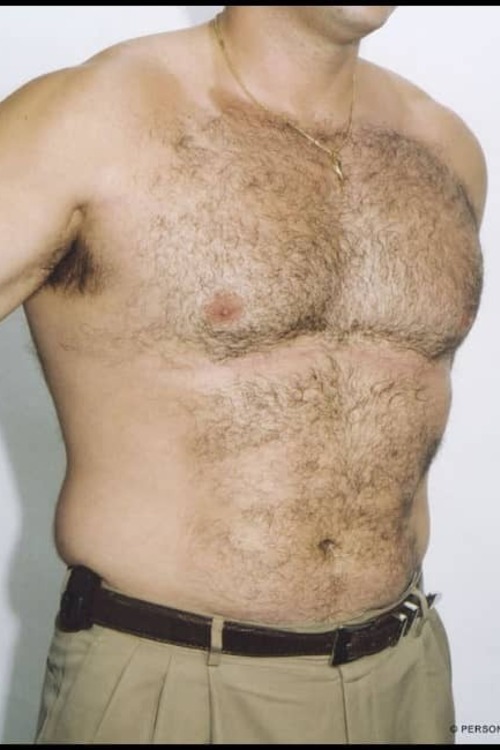 Male Liposuction