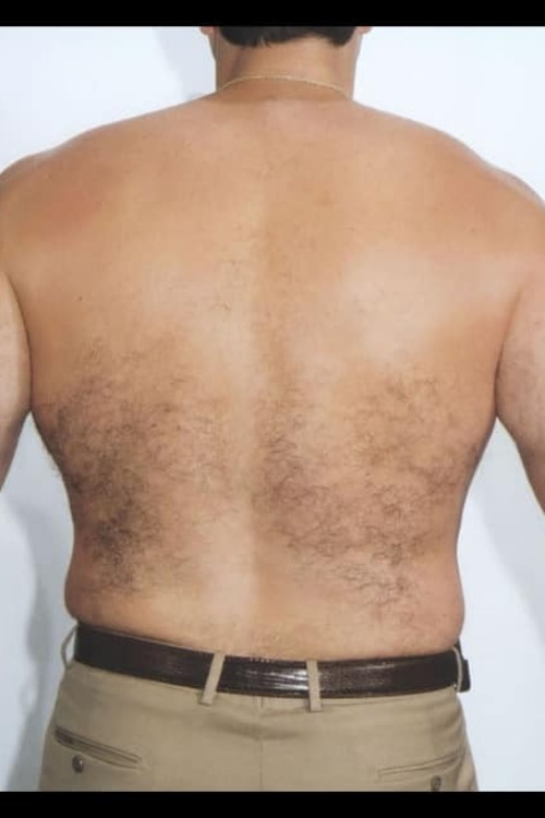 Male Liposuction