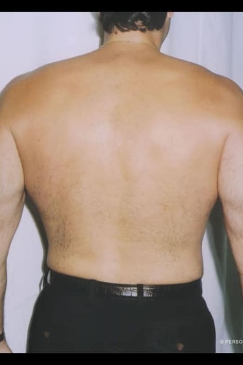 Male Liposuction