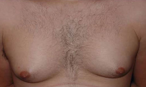 Male Liposuction