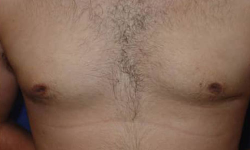 Male Liposuction