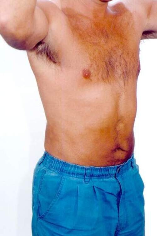 Male Liposuction