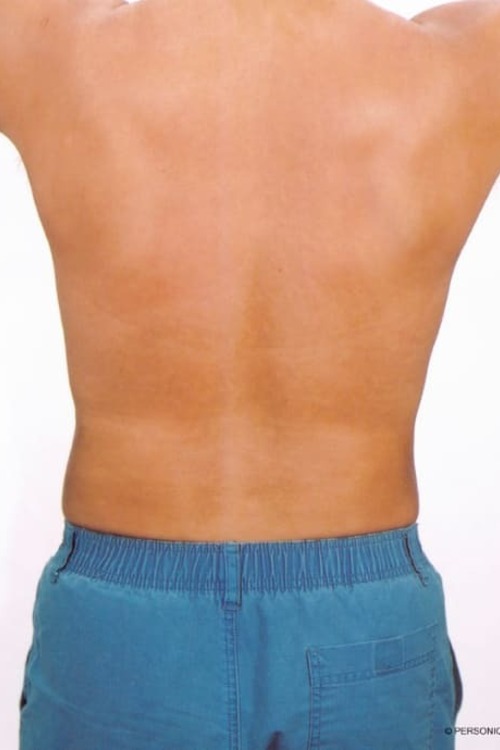 Male Liposuction