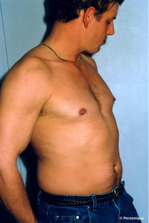 Male Liposuction