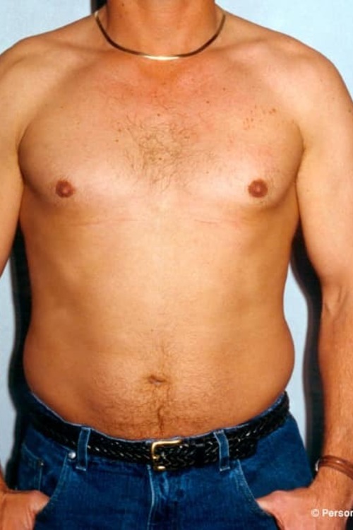 Male Liposuction