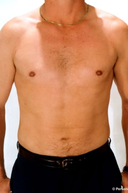 Male Liposuction