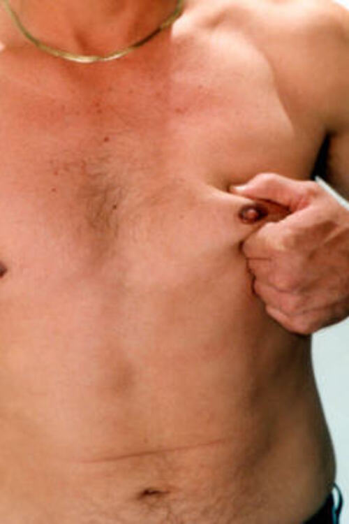 Male Liposuction