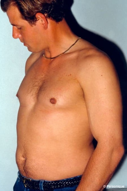 Male Liposuction