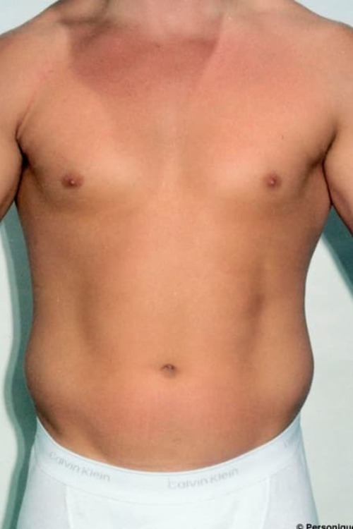 Male Liposuction