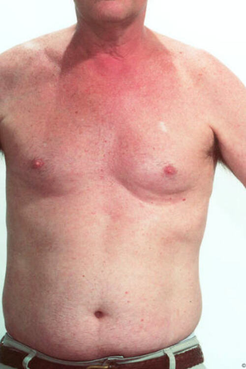 Male Liposuction