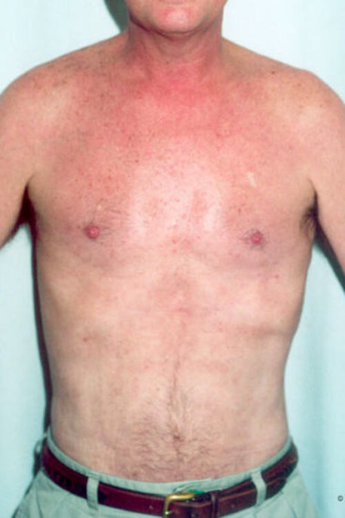 Male Liposuction