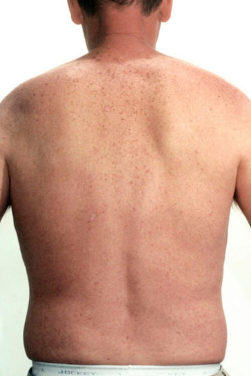 Male Liposuction