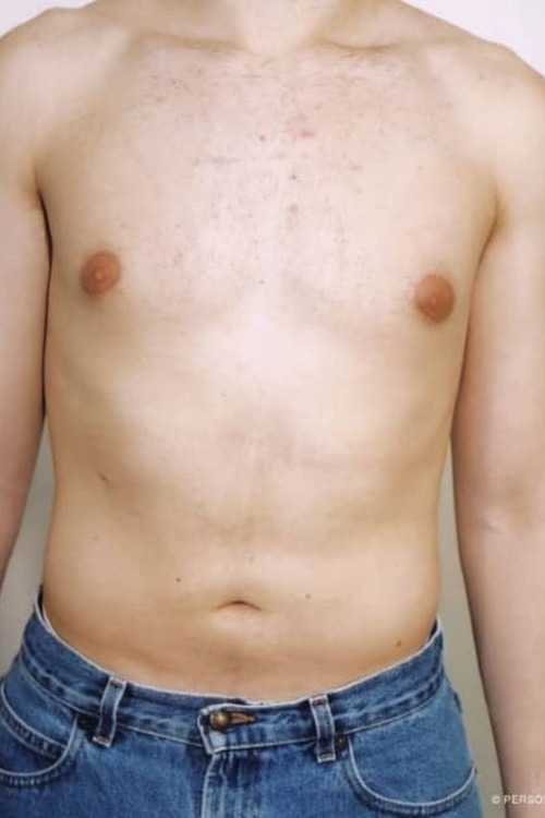 Male Liposuction