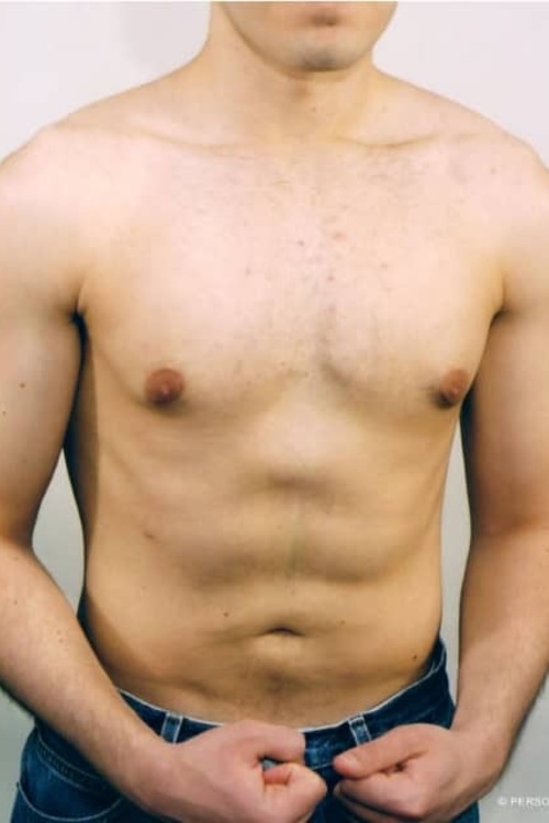 Male Liposuction