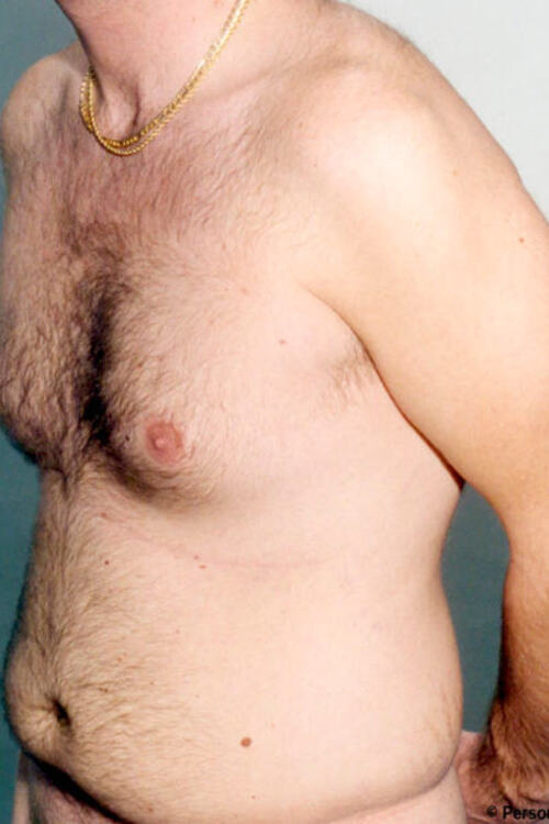 Male Liposuction