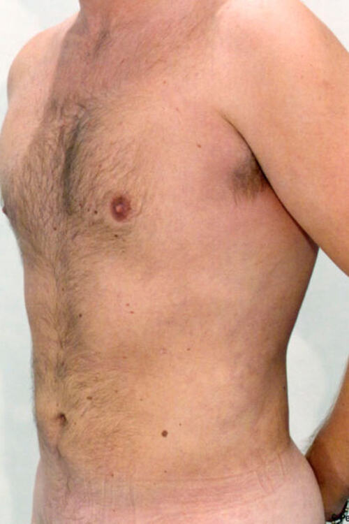 Male Liposuction