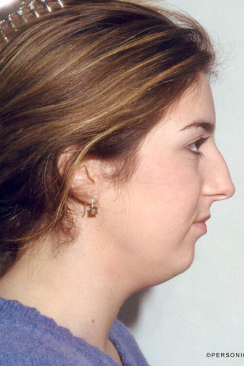 Neck & Face Liposuction