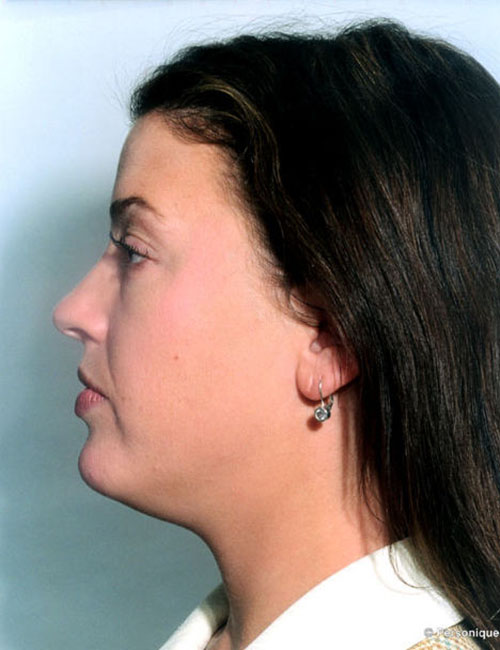 Neck & Face Liposuction