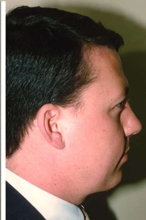 Neck & Face Liposuction