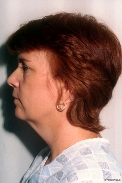 Neck & Face Liposuction