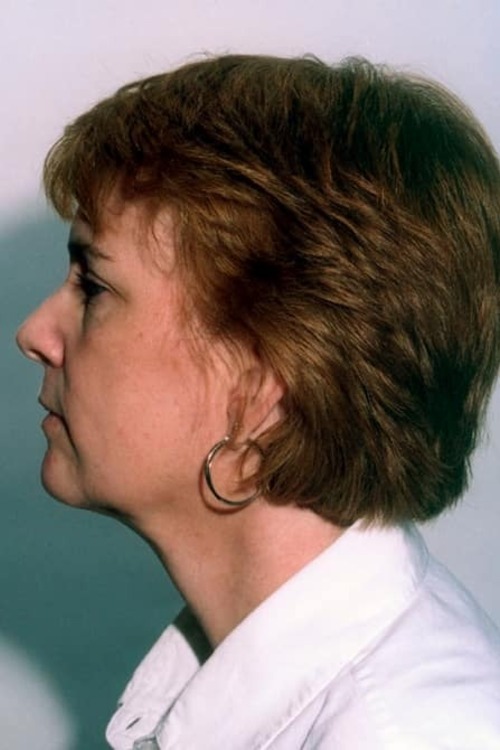 Neck & Face Liposuction