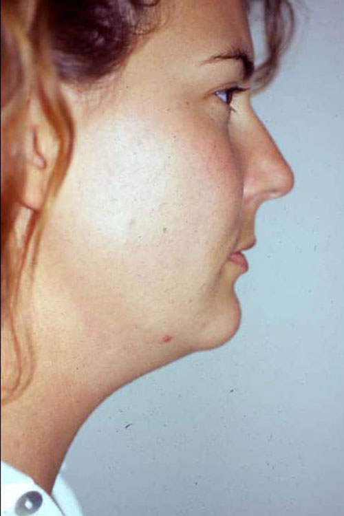 Neck & Face Liposuction