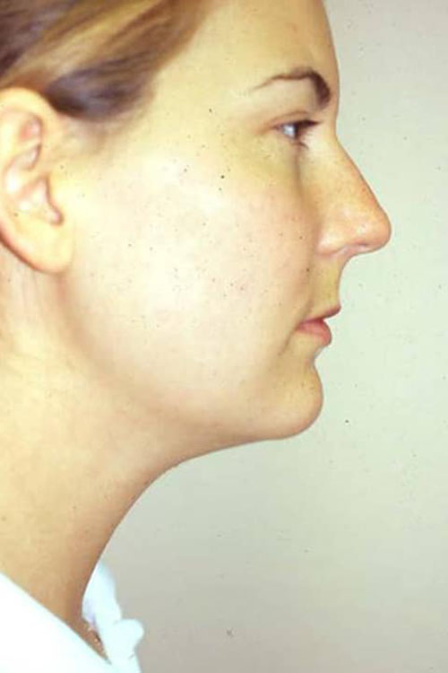 Neck & Face Liposuction