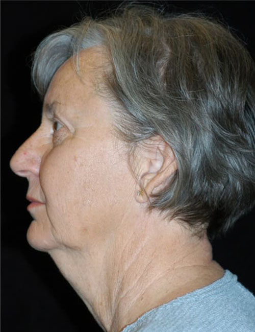 Neck & Face Liposuction