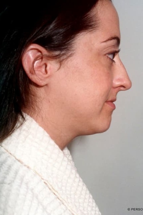 Neck & Face Liposuction