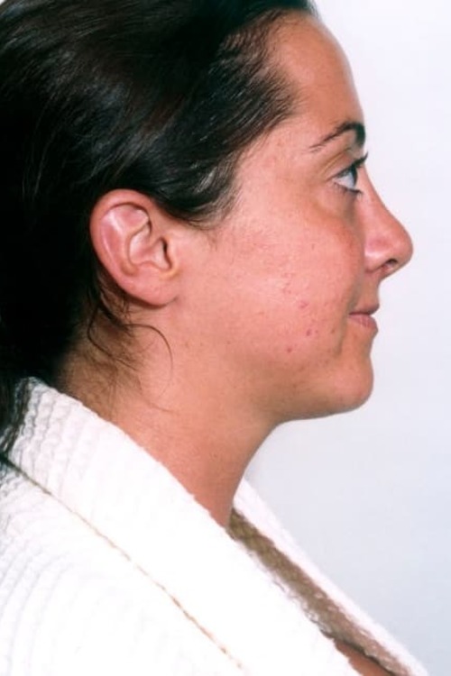 Neck & Face Liposuction