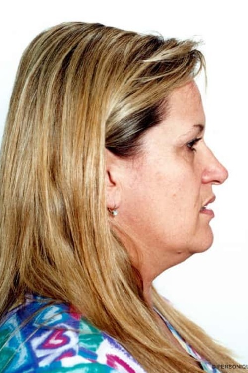 Neck & Face Liposuction