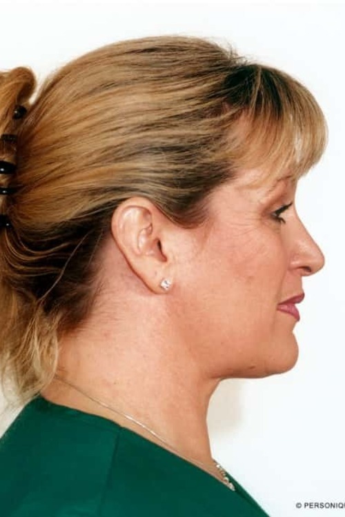 Neck & Face Liposuction