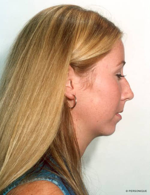 Neck & Face Liposuction