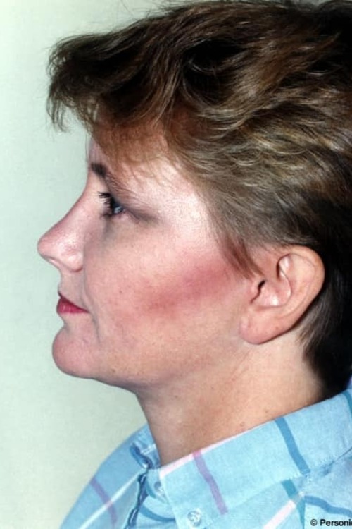 Neck & Face Liposuction