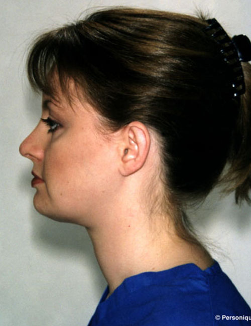 Neck & Face Liposuction