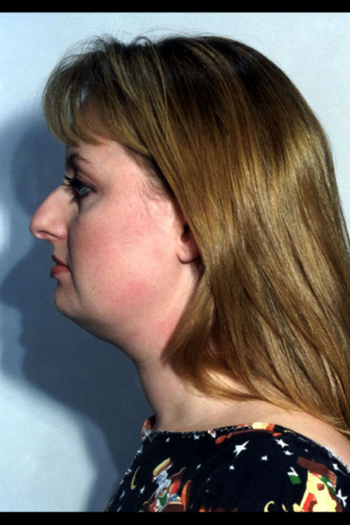 Rhinoplasty