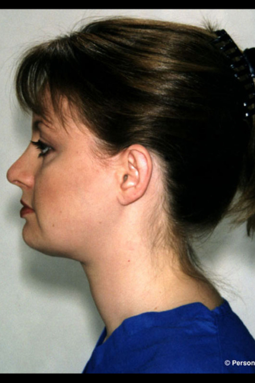 Rhinoplasty