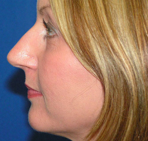 Rhinoplasty