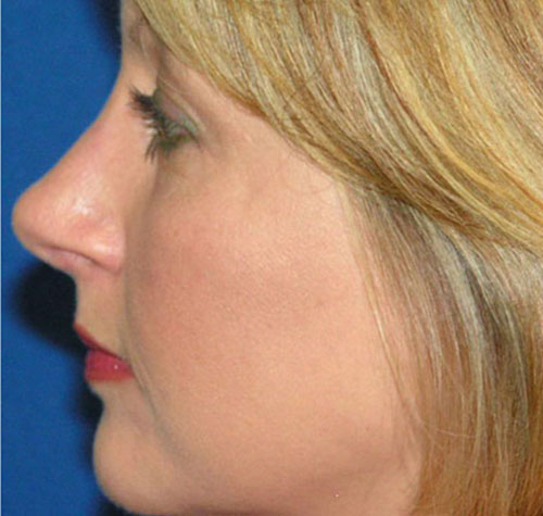 Rhinoplasty