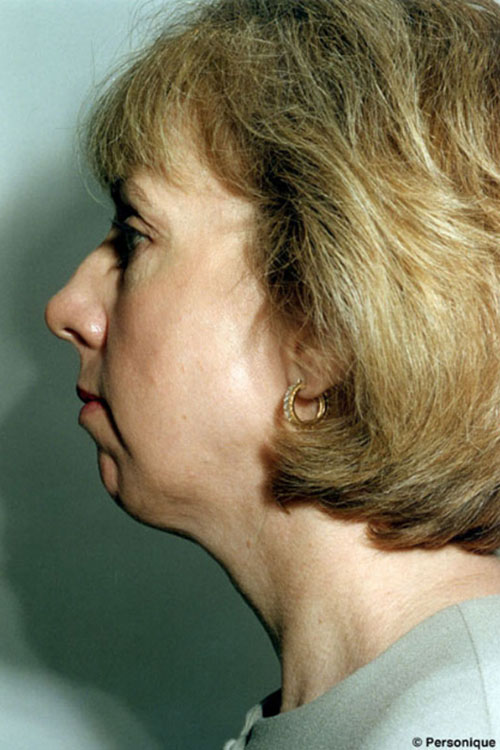 Rhinoplasty