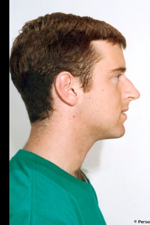 Rhinoplasty