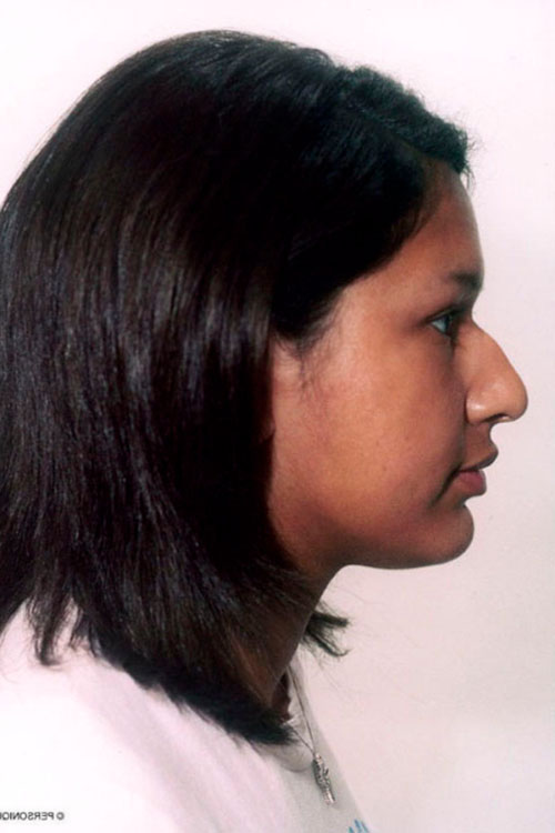 Rhinoplasty